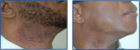 laser hair removal for dark skin Before After Photo