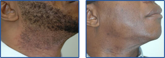 facial hair laser removal before after pictures