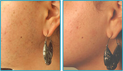 flawless hair removal before and after