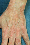 laser hand rejuvenation Before and after Pictures