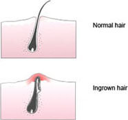 Ingrown Hairs Removal