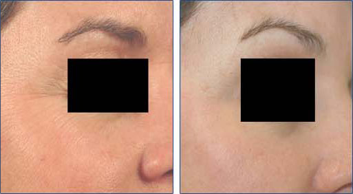 Laser Resurfacing for Wrinkles