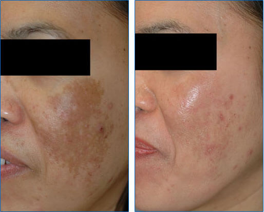 Asian Skin Melasma Laser Treament