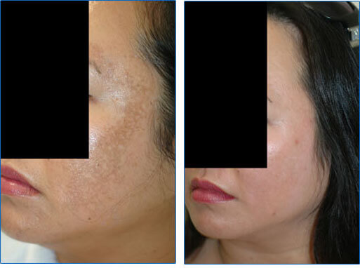 laser acne removal
