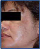 Melasma Treatment