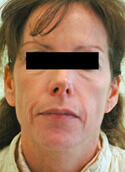 Los Angeles laser resurfacing before and after Pictures