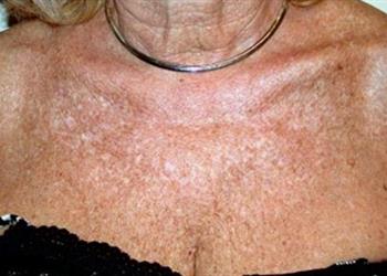 Poikiloderma Discoloration on Neck and Chest