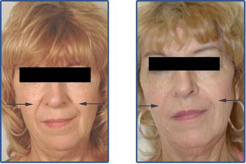 restylane injections