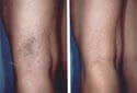 Los Angeles Spider Vein Removal before and after Pictures