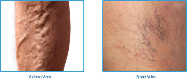 Spider Veins vs Varicose Veins