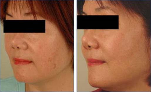 age spots laser treatment