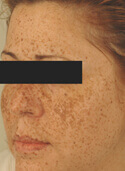 age spot removal Before Pictures