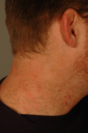Los Angeles Laser Tattoo removal before and After Pictures