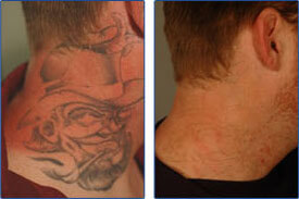 Tattoo Removal Costs