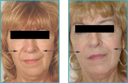 restylane juvederm perlane injections