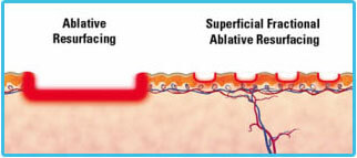 wrinkle laser removal