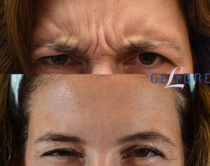 how long does botox last in forehead