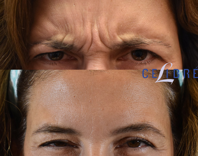 1 Botox Forehead Lines Before And After 3 
