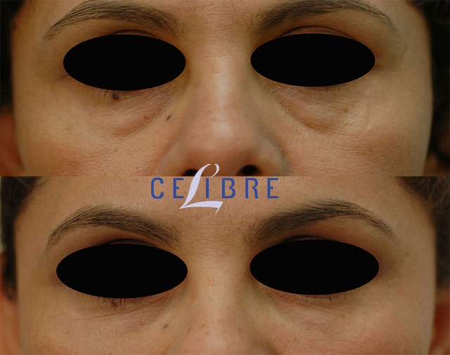 1 - Dark circles juvederm before after