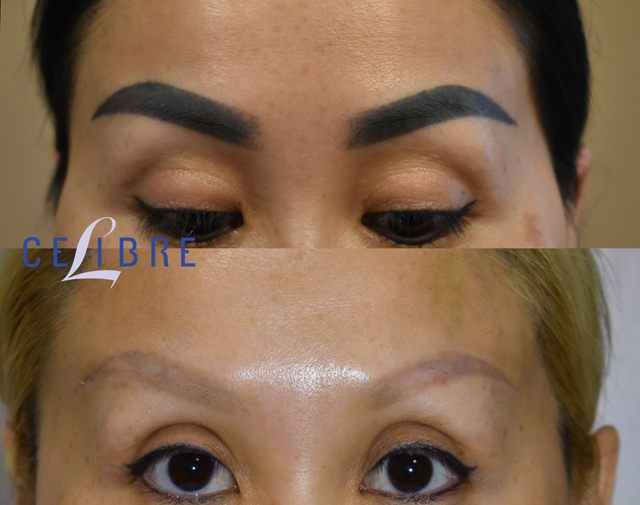 Tattoo Removal - eyebrows, eyeliner, lips by saline and clay