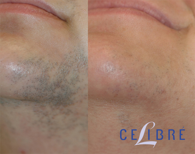 Laser Hair Removal Before and After Pictures of Actual Patients