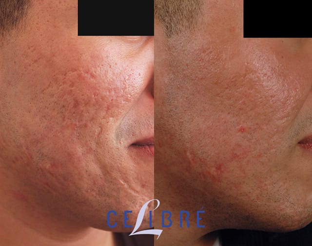 Acne Scar Removal Before And After Pictures Of Actual Patients Acne Scar Removal Before And After Pictures Of Actual Patients