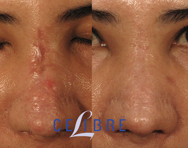Scar removal with laser before after