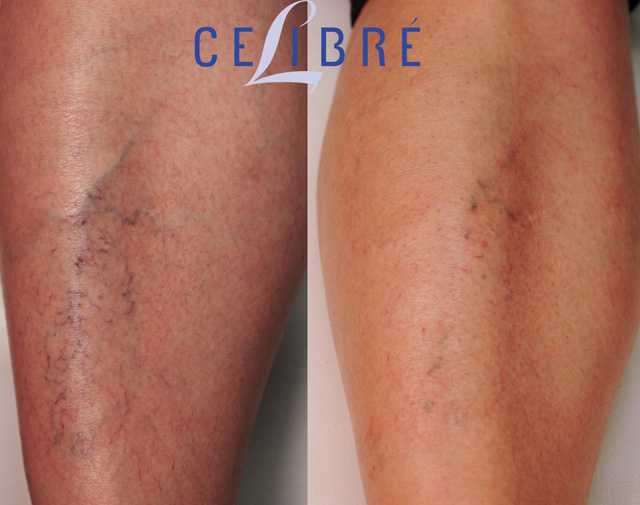 Laser Treatment for Spider Veins: Before and After Photos, Recovery
