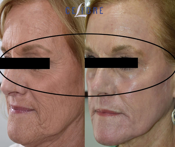 Before and after laser resurfacing reveals smoother under-eye skin, softened wrinkles, brighter texture, refreshed confidence, youthful appearance with visible improvement.