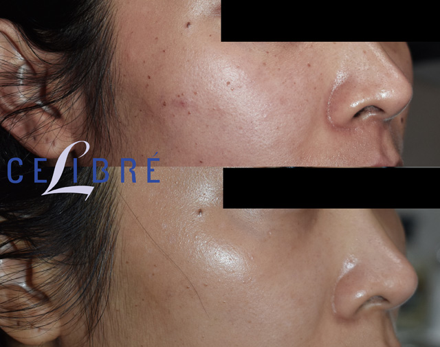 Asian skin mole removal before and after photos showing clear, smooth skin and noticeable improvement in complexion.