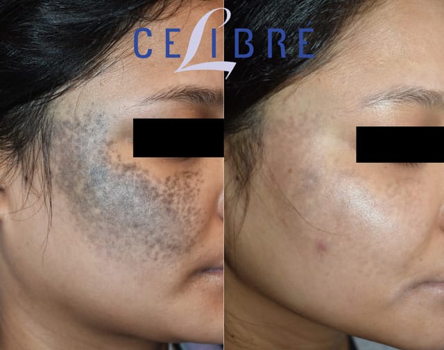 Dysplastic Nevus Laser Removal