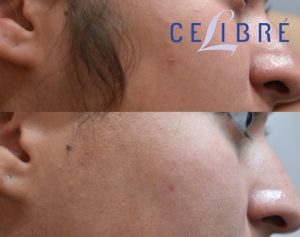 permanent laser hair removal before and after photos