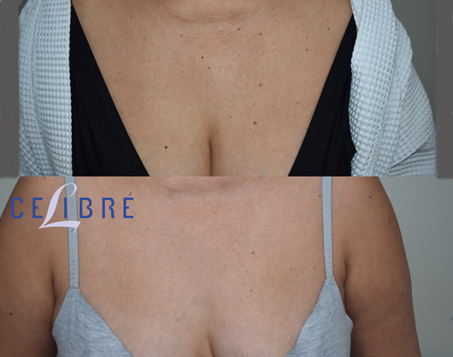 Safe mole removal treatment visibly clears unwanted skin growths, improving skin appearance with clean, smooth results shown in before and after photos.