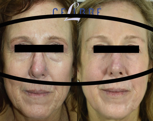 Smooth wrinkles around the eyes naturally with retinol, hydration, sunscreen, facial massage, sleep, collagen support, and gentle skincare every day.