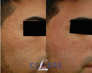Laser Treatment for Acne Scars