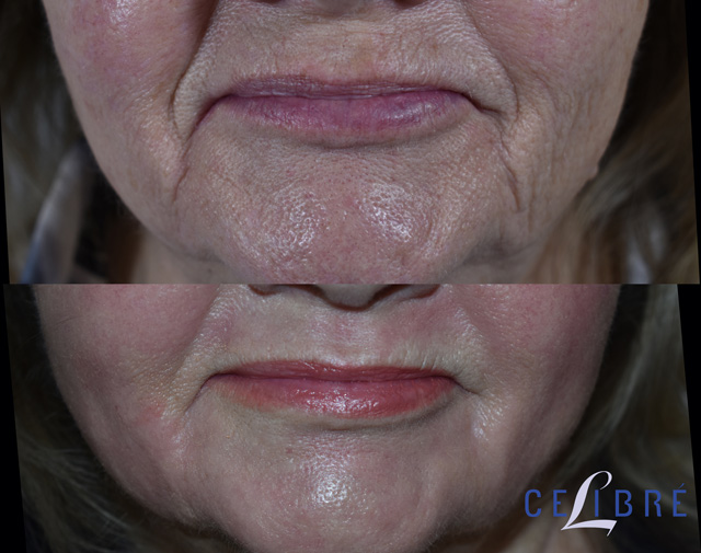 https://celibre.com/wp-content/uploads/11-lip-lines-and-chin-pore-size-before-after-laser-resurfacing.jpg