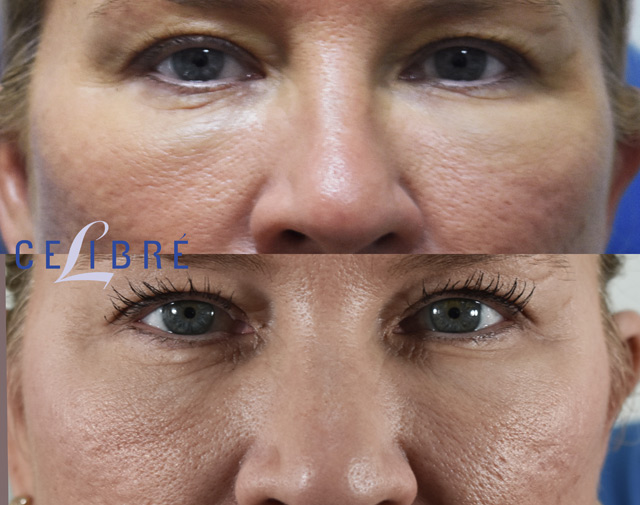 under eye filler reversal before after hyaluronidase