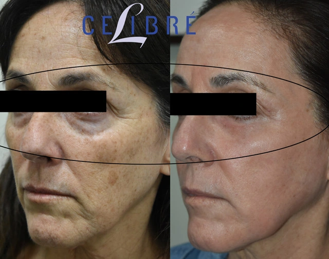 Under eye wrinkle removal with laser before after reveals smoother skin, softened lines, brighter eyes, refreshed appearance, youthful confidence, naturally.