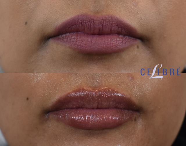 fullips before and after