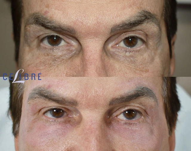 Hollow and wrinkly under eyes improved with laser treatment, smoother skin, refreshed appearance, brighter eyes, renewed confidence over time naturally.