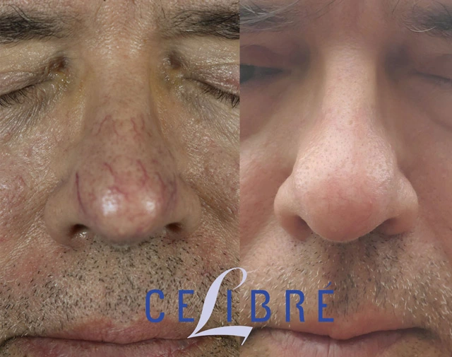Laser treatment for spider veins on the nose before and after photos showing visible improvement in facial redness and broken blood vessels.