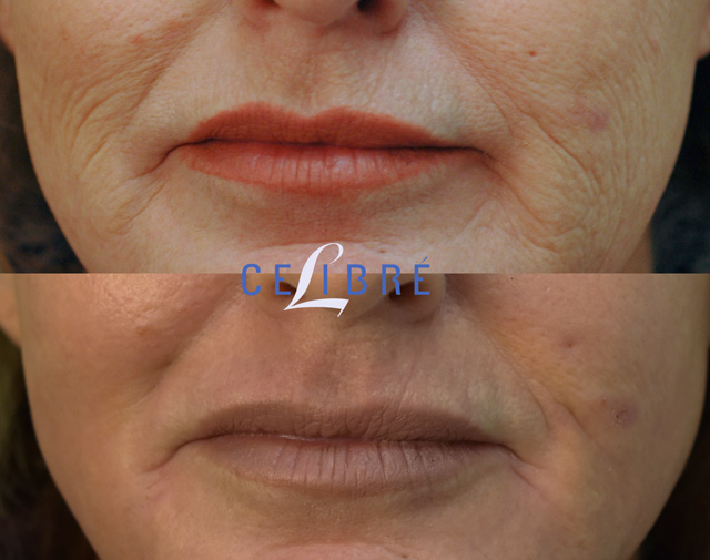 Getting Rid Pesky Fine Lines Around the Mouth - Dr T Aesthetics