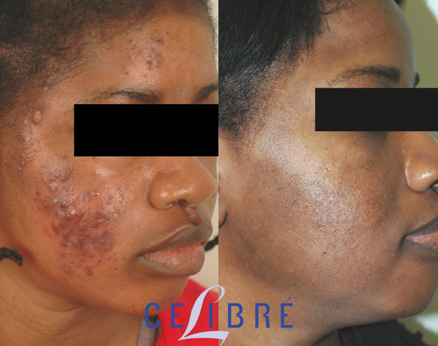 Scars, Repair Scars from Acne, Surgery, & More