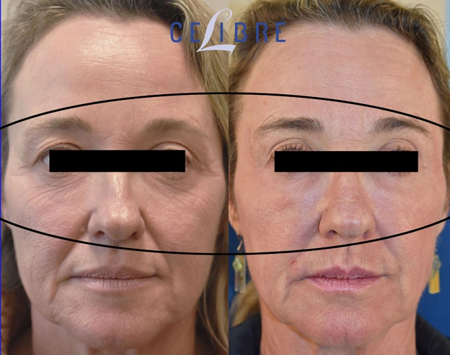 Upper cheek wrinkles under the eyes laser resurfacing before after shows smoother skin, reduced lines, brighter eyes, refreshed appearance naturally.