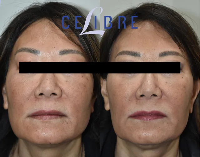 Achieve a slimmer look with asian-jaw-slimming-with-botox-before-after results