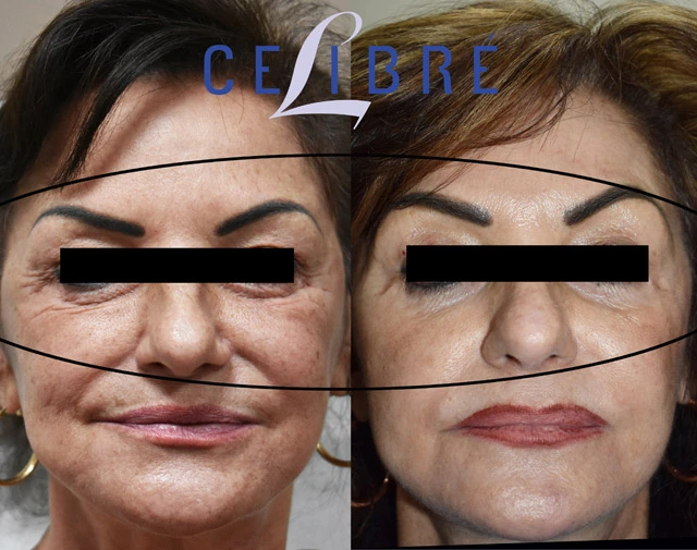 Fixing loose skin under the eyes with laser helps tighten skin, smooth wrinkles, refresh appearance, restore confidence with noticeable improvements.