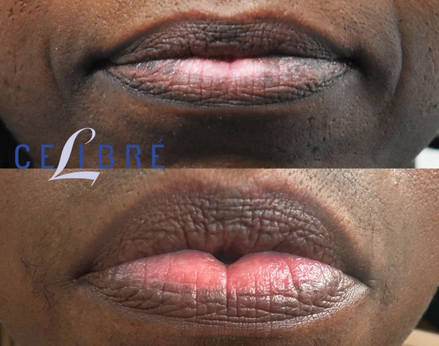 Brown Spots on Lips Treatments | Results in 47 Days Brown Spots on Lips Treatments | Results in 47 Days