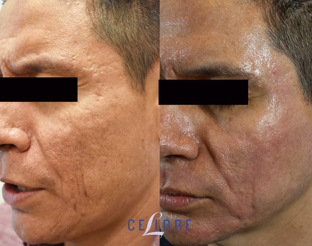 Acne Scar Removal Before And After Pictures Of Actual Patients 8529