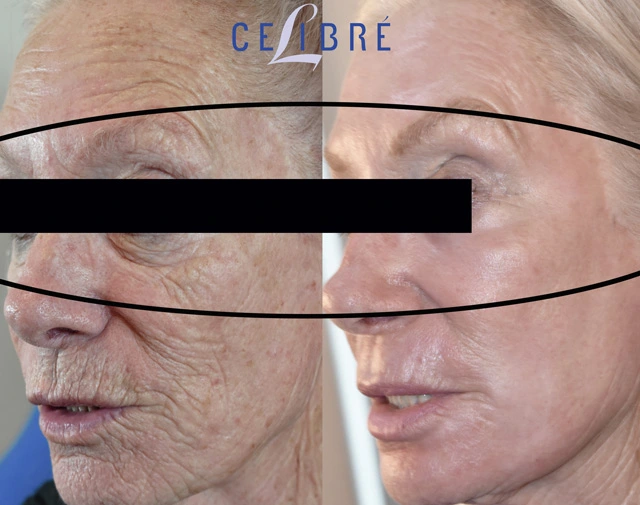 How to fix crepey skin under the eyes with hydration, retinol, sunscreen, sleep, treatments, gentle skincare for smoother youthful looking.