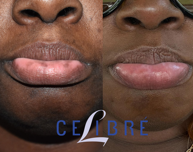 Before and after laser treatment for lip spots – showing clearer, smoother lips after removal.
